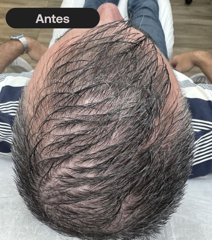 Antes do tratamento