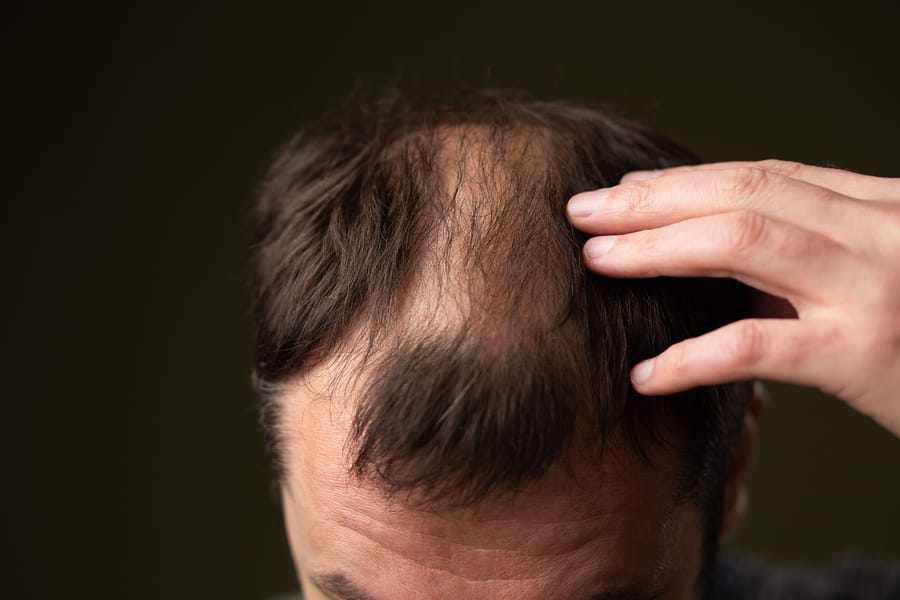 Avaliando perda de cabelo em close-up