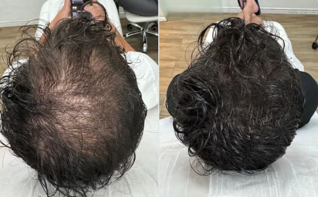 Resultado de restauração capilar — antes e depois