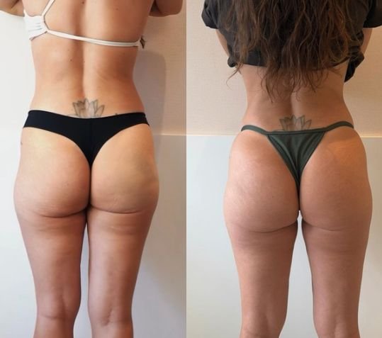 Resultado de tratamento corporal de celulite e flacidez — antes e depois