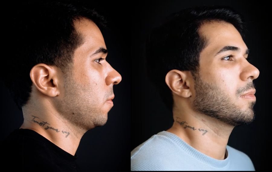 Resultado de estruturação facial — antes e depois