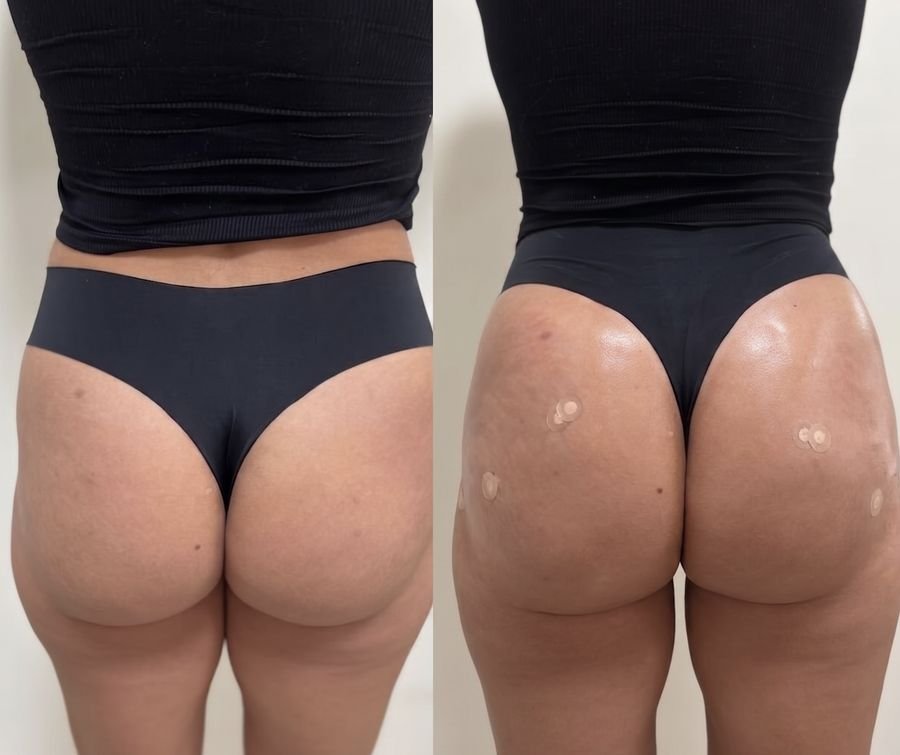 Resultado de harmonização glútea — antes e depois