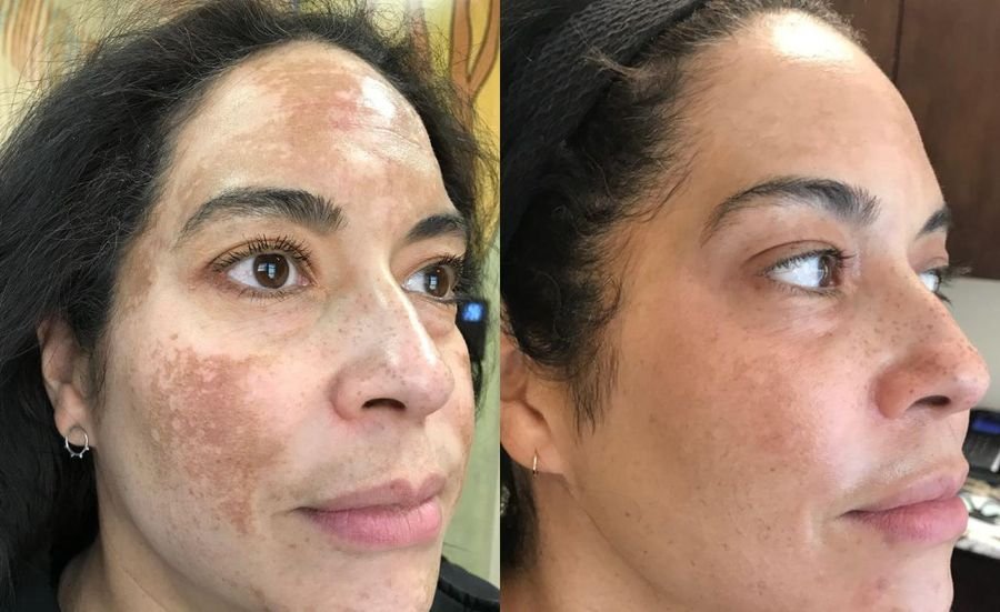 Resultado de tratamento de melasma e manchas — antes e depois