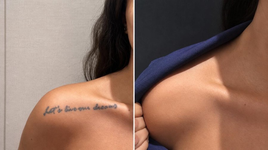 Resultado de remoção de tatuagem a laser no ombro — antes e depois